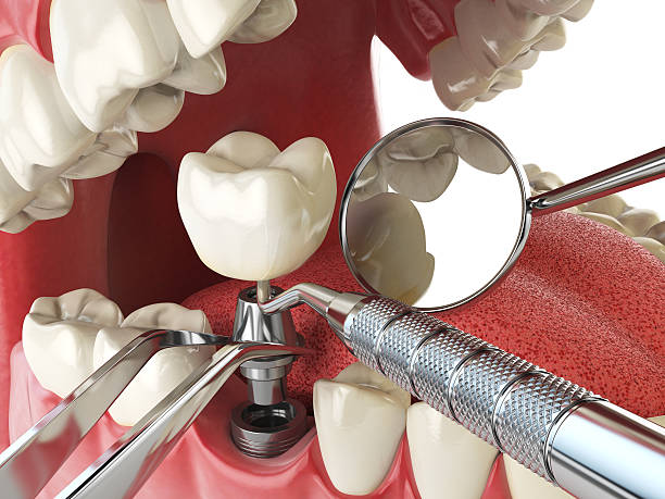 Best Emergency Dental Care for Abscessed Tooth in Panhandle, TX